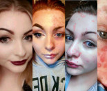 Makijażystka z Instagrama przyznała, że ukrywała łuszczycę! (FOTO)